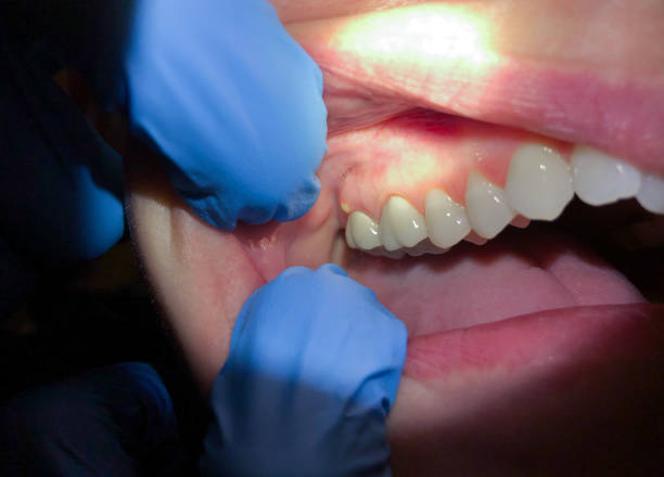 Best Emergency Dentist for Lost Fillings or Crowns in Independence, VA